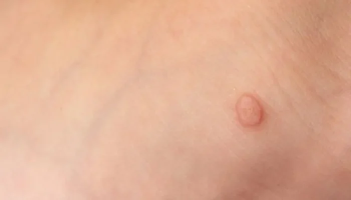 Kutil: Penyebab, Gejala, dan Pengobatannya