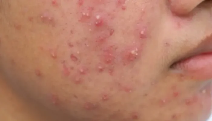 Cara Ampuh Menghilangkan Jerawat Batu